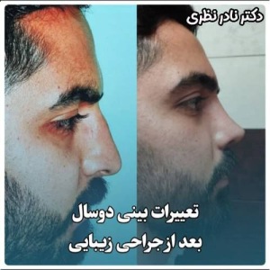 1_جراحی-بینی-6