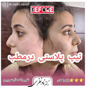 عکس نمونه کار قبل و بعد از جراحی تیپ پلاستی بینی استخوانی