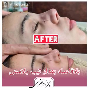 عکس قبل و بعد جراحی بینی استخوانی در کرمانشاه