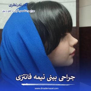 عکس جراحی بینی نیمه فانتزی (نمونه عمل)