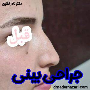 جراحی بینی استخوانی . عکس قبل و بعد عمل