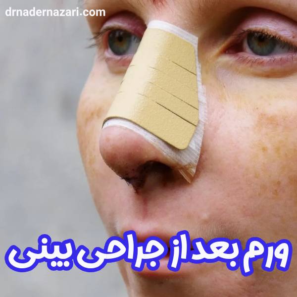 عکس ورم بعد از جراحی بینی
