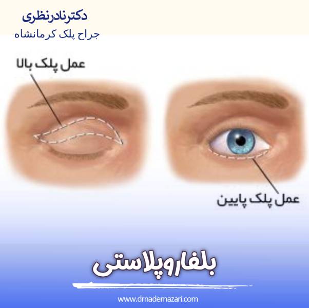 عکس بلفاروپلاستی 