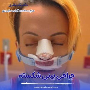 جراحی بینی شکسته