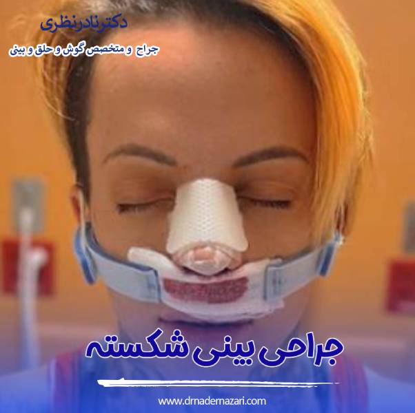 جراحی بینی شکسته