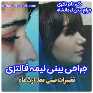 جراحی بینی نیمه فانتزی
